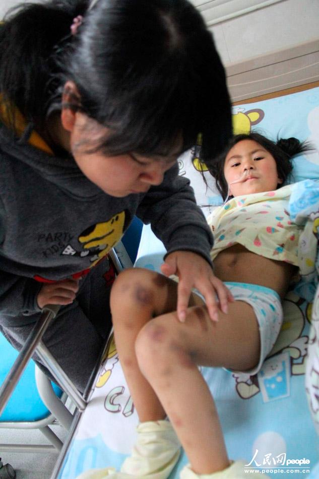 高清组图：重庆一幼儿园上百幼儿下肢皮肤出现淤点 疑似中毒【4】