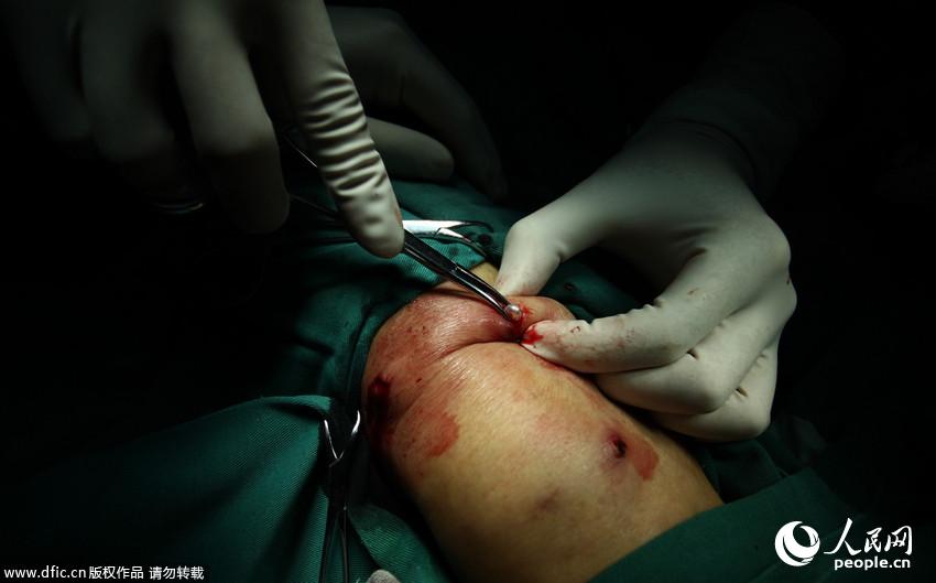 2014年2月21日，湖南长沙，长沙61岁男子邹某接受手术治疗，医生正在实施手术，将埋在邹某体内的珍珠取出。2011年邹某听信“名医”在体内埋下42颗珍珠可治愈骨科疾病。周强/东方IC 