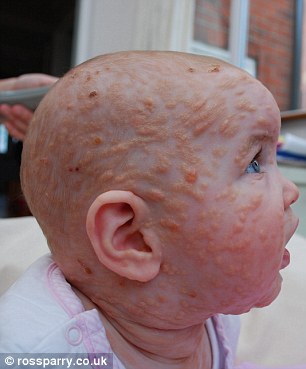 英国6岁女童患罕见皮疹 浑身粉红色斑点