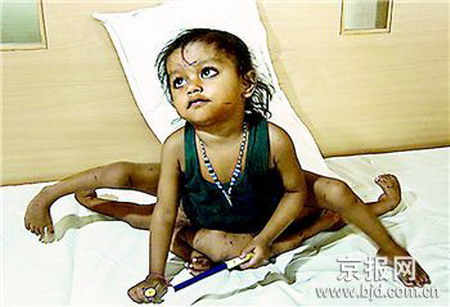 4条胳膊4条腿 印度“蜘蛛女孩”6日“分身”