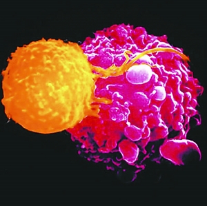 华裔科学家克隆T细胞治愈皮肤癌