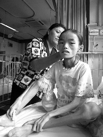 山东12岁女孩患怪病成皮包骨体重降到21公斤