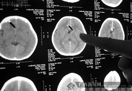 小孩的脑部CT扫描显示:筷子(脑部阴影部分)通